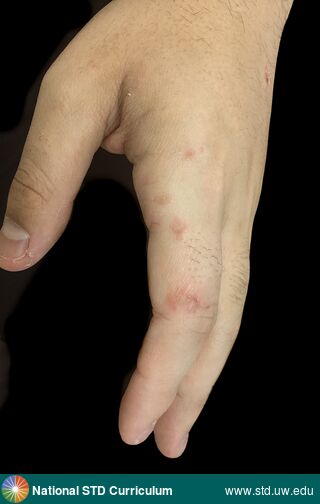 Diagnosis: Scabies, Clinical Signs: Erythema, Papule / Papules, Locations: Hand (Left), Symptoms: Itch, Image Type: Photo