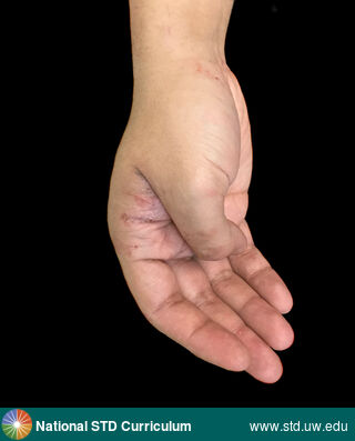 Diagnosis: Scabies, Clinical Signs: Erythema, Papule / Papules, Locations: Hand (Right), Symptoms: Itch, Image Type: Photo