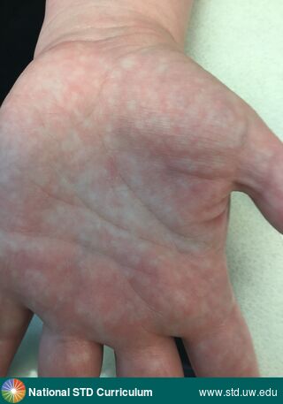 Diagnosis: Syphilis-Secondary, Clinical Signs: Erythema, Macule / Macules, Locations: Hand (Left), Symptoms: Non-Painful, Image Type: Photo
