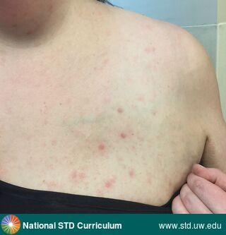 Diagnosis: Syphilis-Secondary, Clinical Signs: N/A, Locations: N/A, Symptoms: N/A, Image Type: Photo