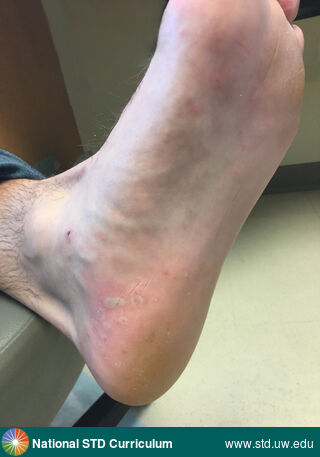Diagnosis: Syphilis-Secondary, Clinical Signs: Annular, Papule / Papules, Pustule / Pustules, Locations: Feet/Soles, Light skin tone, Symptoms: Non-Painful, Image Type: Photo