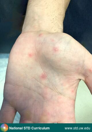 Diagnosis: Syphilis-Secondary, Clinical Signs: Annular, Erythema, Macule / Macules, Papule / Papules, Locations: Arm (Left), Light skin tone, Symptoms: Non-Painful, Image Type: Photo