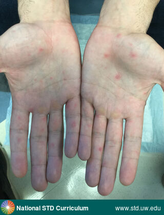 Diagnosis: Syphilis-Secondary, Clinical Signs: Annular, Erythema, Macule / Macules, Papule / Papules, Locations: Hand (Left), Hand (Right), Light skin tone, Symptoms: N/A, Image Type: Photo