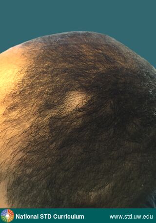 Diagnosis: Syphilis-Secondary, Clinical Signs: Patch/Patches, Locations: Dark skin tone, Scalp, Symptoms: Non-Itchy, Non-Painful, Image Type: Photo