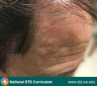 Diagnosis: Herpes Zoster / Shingles, Clinical Signs: Erythema, Papule / Papules, Vesicle / Vesicles, Locations: Face, Light skin tone, Symptoms: Painful, Rash, Image Type: Photo