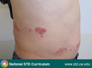 Diagnosis: Herpes Zoster / Shingles, Clinical Signs: Erythema, Vesicle / Vesicles, Locations: Abdomen, Back, Light skin tone, Symptoms: Painful, Image Type: Photo