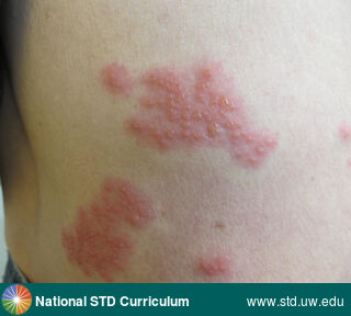 Diagnosis: Herpes Zoster / Shingles, Clinical Signs: Erythema, Vesicle / Vesicles, Locations: Back, Light skin tone, Symptoms: Painful, Image Type: Photo