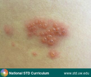 Diagnosis: Herpes Zoster / Shingles, Clinical Signs: Erythema, Vesicle / Vesicles, Locations: Back, Light skin tone, Symptoms: Painful, Image Type: Photo