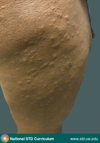 Diagnosis: Syphilis-Secondary, Clinical Signs: Papule / Papules, Locations: Dark skin tone, Thigh, Symptoms: N/A, Image Type: Photo