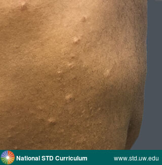Diagnosis: Syphilis-Secondary, Clinical Signs: Papule / Papules, Locations: Back, Dark skin tone, Symptoms: N/A, Image Type: Photo