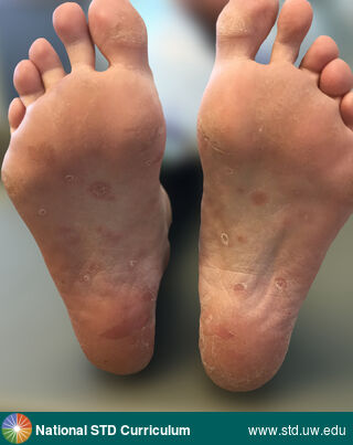 Diagnosis: Syphilis-Secondary, Clinical Signs: Annular, Macule / Macules, Papule / Papules, Locations: Feet, Symptoms: Non-Painful, Rash, Image Type: Photo