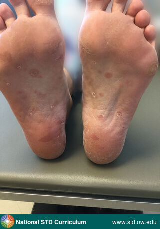 Diagnosis: Syphilis-Secondary, Clinical Signs: Annular, Hyperpigmentation, Macule / Macules, Papule / Papules, Locations: Feet/Soles, Symptoms: Non-Painful, Rash, Image Type: Photo