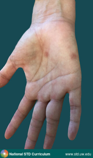 Diagnosis: Syphilis-Secondary, Clinical Signs: Annular, Hyperpigmentation, Macule / Macules, Papule / Papules, Locations: Hand (Right), Symptoms: Non-Painful, Rash, Image Type: Photo