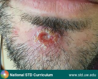 Diagnosis: Syphilis-Primary, Clinical Signs: Scale, Ulcer / Ulcers, Locations: Face, Light skin tone, Symptoms: Non-Painful, Image Type: Photo