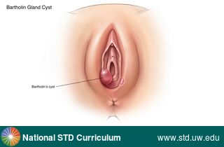 Diagnosis: Bartholin Galand Cyst/Abscess, Clinical Signs: Cyst, Edema / Swelling, Locations: Light skin tone, Vulva, Symptoms: N/A, Image Type: Illustration