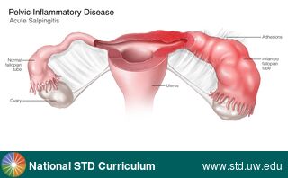 Diagnosis: Pelvic Inflammatory Disease, Clinical Signs: Edema / Swelling, Locations: Female Genitourinary, Symptoms: Painful, Image Type: Illustration
