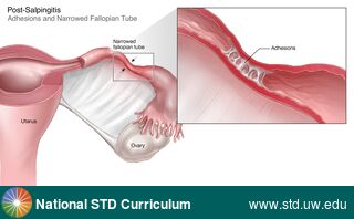 Diagnosis: Pelvic Inflammatory Disease, Clinical Signs: N/A, Locations: Female Genitourinary, Symptoms: Painful, Image Type: Illustration