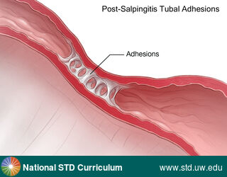 Diagnosis: Pelvic Inflammatory Disease, Clinical Signs: N/A, Locations: Female Genitourinary, Symptoms: Painful, Image Type: Illustration