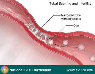 Diagnosis: Pelvic Inflammatory Disease, Clinical Signs: N/A, Locations: Female Genitourinary, Symptoms: Painful, Image Type: Illustration