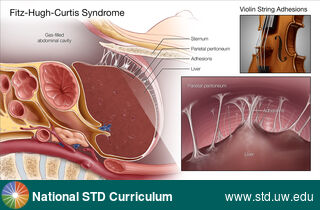 Diagnosis: Pelvic Inflammatory Disease, Clinical Signs: N/A, Locations: Abdomen, Symptoms: Painful, Image Type: Illustration