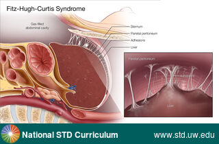 Diagnosis: Pelvic Inflammatory Disease, Clinical Signs: N/A, Locations: Abdomen, Symptoms: Painful, Image Type: Illustration