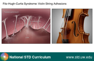 Diagnosis: Pelvic Inflammatory Disease, Clinical Signs: N/A, Locations: Abdomen, Symptoms: Painful, Image Type: Illustration