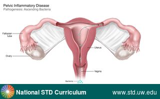 Diagnosis: Pelvic Inflammatory Disease, Clinical Signs: N/A, Locations: Female Genitourinary, Symptoms: Painful, Image Type: Illustration