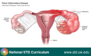 Diagnosis: Pelvic Inflammatory Disease, Clinical Signs: Edema / Swelling, Locations: Female Genitourinary, Symptoms: Painful, Image Type: Illustration