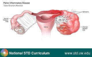 Diagnosis: Pelvic Inflammatory Disease, Clinical Signs: Edema / Swelling, Mass, Locations: Female Genitourinary, Symptoms: Painful, Image Type: Illustration