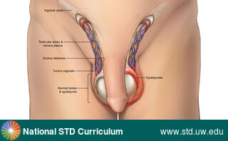 Diagnosis: Epididymitis, Clinical Signs: Edema / Swelling, Locations: Epididymis, Penis, Scrotum, Symptoms: Painful, Image Type: Illustration