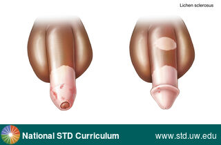 Diagnosis: Lichen sclerosus, Clinical Signs: Hypopigmentation, Plaque, Locations: Dark skin tone, Penis, Symptoms: Itch, Image Type: Illustration