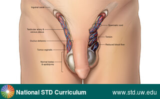 Diagnosis: Testicular Torsion, Clinical Signs: Edema / Swelling, Locations: Epididymis, Light skin tone, Scrotum, Symptoms: Painful, Image Type: Illustration