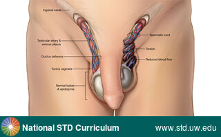 Diagnosis: Testicular Torsion, Clinical Signs: Edema / Swelling, Locations: Epididymis, Light skin tone, Scrotum, Symptoms: Painful, Image Type: Illustration