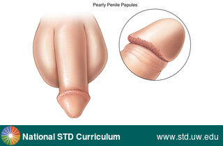 Diagnosis: Pearly penile papules, Clinical Signs: Papule / Papules, Locations: Light skin tone, Penis, Symptoms: Non-Itchy, Non-Painful, Image Type: Illustration