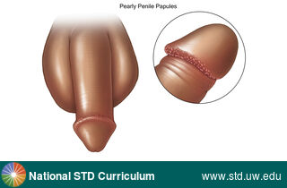 Diagnosis: Pearly penile papules, Clinical Signs: Papule / Papules, Locations: Dark skin tone, Penis, Symptoms: Non-Itchy, Non-Painful, Image Type: Illustration