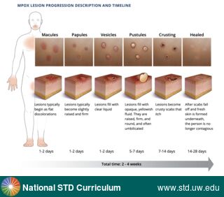 Diagnosis: Mpox, Clinical Signs: Macule / Macules, Papule / Papules, Pustule / Pustules, Rash, Scab, Ulcer / Ulcers, Vesicle / Vesicles, Locations: N/A, Symptoms: N/A, Image Type: Illustration