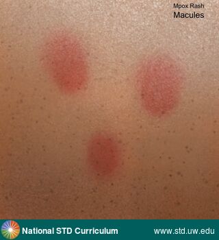 Diagnosis: Mpox, Clinical Signs: Erythema, Macule / Macules, Rash, Locations: N/A, Symptoms: Rash, Image Type: Illustration