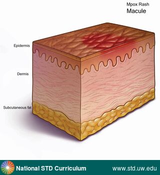 Diagnosis: Mpox, Clinical Signs: Erythema, Macule / Macules, Rash, Locations: N/A, Symptoms: Rash, Image Type: Illustration