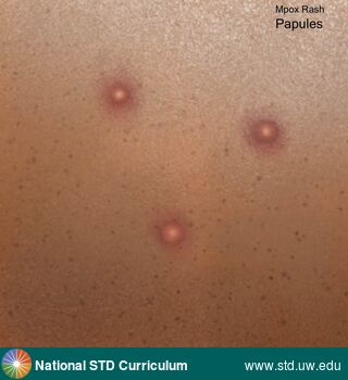 Diagnosis: Mpox, Clinical Signs: Papule / Papules, Rash, Locations: N/A, Symptoms: Rash, Image Type: Illustration