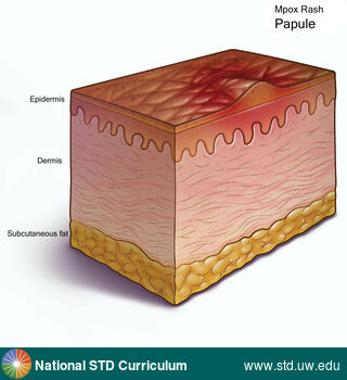 Diagnosis: Mpox, Clinical Signs: Papule / Papules, Rash, Locations: N/A, Symptoms: Rash, Image Type: Illustration