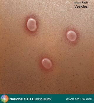 Diagnosis: Mpox, Clinical Signs: Rash, Vesicle / Vesicles, Locations: N/A, Symptoms: Rash, Image Type: Illustration
