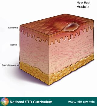 Diagnosis: Mpox, Clinical Signs: Rash, Vesicle / Vesicles, Locations: N/A, Symptoms: Rash, Image Type: Illustration