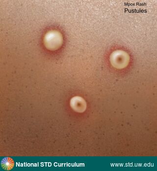 Diagnosis: Mpox, Clinical Signs: Pustule / Pustules, Rash, Locations: N/A, Symptoms: Rash, Image Type: Illustration