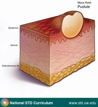 Diagnosis: Mpox, Clinical Signs: Pustule / Pustules, Rash, Locations: N/A, Symptoms: Rash, Image Type: Illustration