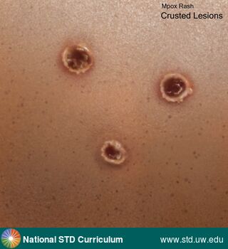 Diagnosis: Mpox, Clinical Signs: Rash, Scab, Ulcer / Ulcers, Locations: N/A, Symptoms: Rash, Image Type: Illustration