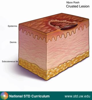 Diagnosis: Mpox, Clinical Signs: Rash, Scab, Ulcer / Ulcers, Locations: N/A, Symptoms: Rash, Image Type: Illustration