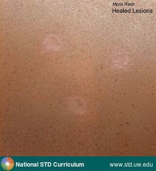 Diagnosis: Mpox, Clinical Signs: N/A, Locations: N/A, Symptoms: N/A, Image Type: Illustration