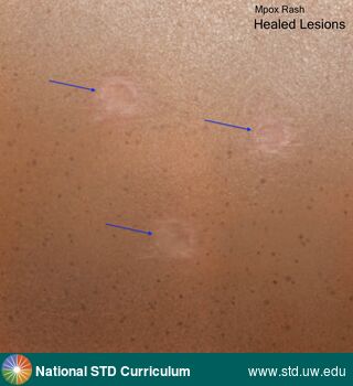 Diagnosis: Mpox, Clinical Signs: N/A, Locations: N/A, Symptoms: N/A, Image Type: Illustration