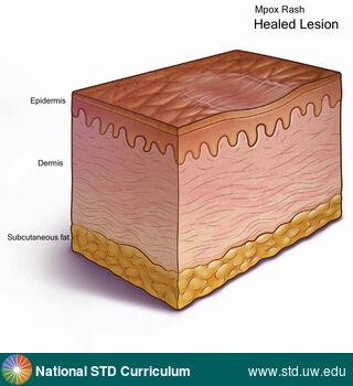 Diagnosis: Mpox, Clinical Signs: N/A, Locations: N/A, Symptoms: N/A, Image Type: Illustration