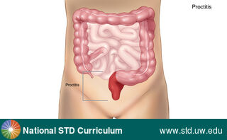 Diagnosis: Proctitis / Proctocolitis, Clinical Signs: Discharge / Anal, Locations: Abdomen, Symptoms: Discharge, Painful, Image Type: Illustration